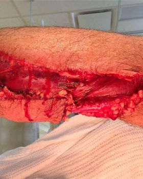 Leg gash