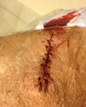 The aftermath of a BCC excision