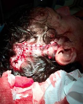 head stitches