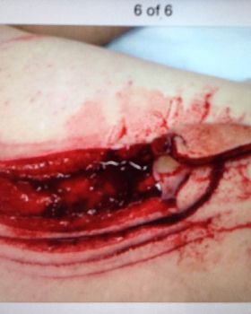 Shark bite