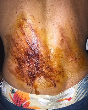 wound