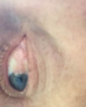 Let my pterygium speak for itself