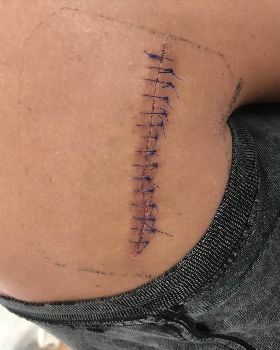 Medi stiched