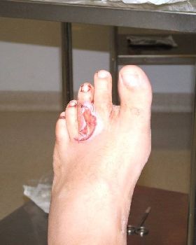 Wound