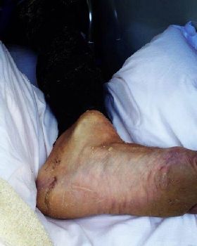 Daves Ankle