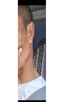 Laceration