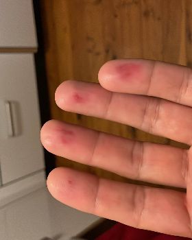 Bruised fingers