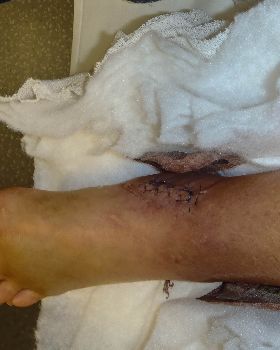 injury