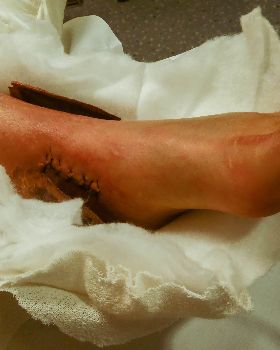 injury 1