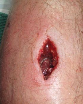 Hole in Leg