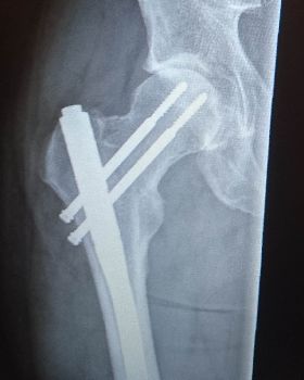 The bionic man, without the bionics
