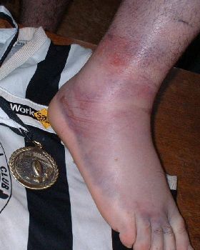 non-w/surfing ankle injury