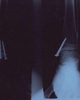Screwed up ankle
