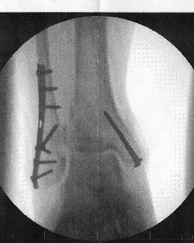 Ankle and screws001
