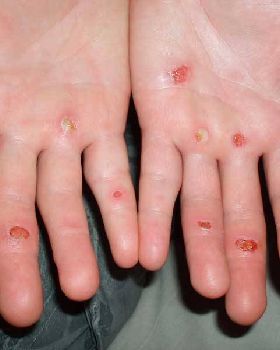 Nananu-i-Ra Blisters