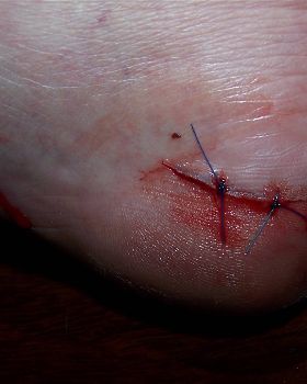 Fin Damage