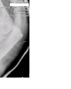 elbow