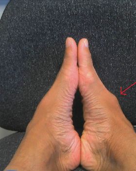 Foot injury
