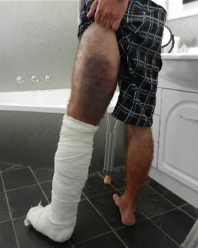 CrackerJack's broken leg