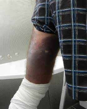 CrackerJack's broken leg