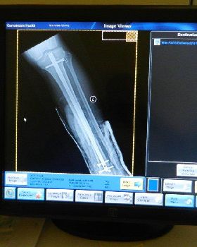 My new leg