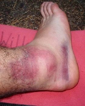 sprainedankle