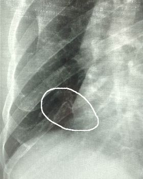 RIBS1