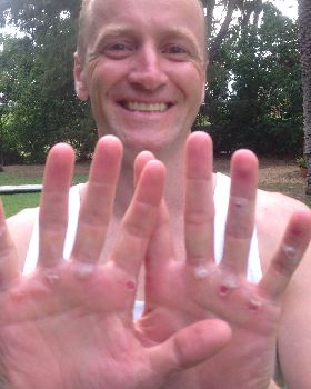 Sore hands