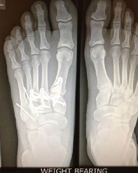 foot pain yes 186